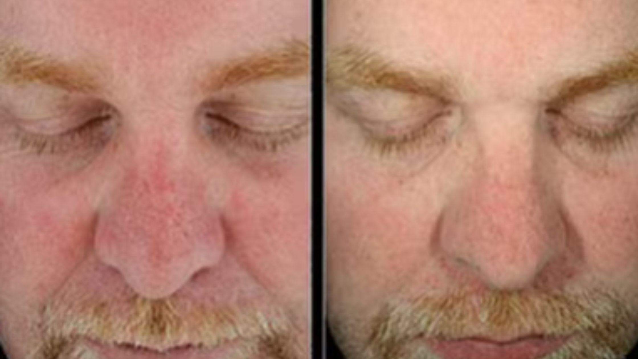 Why Photofacial Treatment in Mississauga is the Upgrade Your Skin’s Been Waiting For?