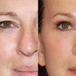 Eye Bag Surgery: A Complete Guide to Youthful Eyes