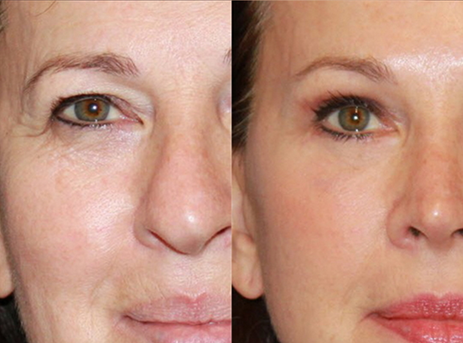 Eye Bag Surgery: A Complete Guide to Youthful Eyes