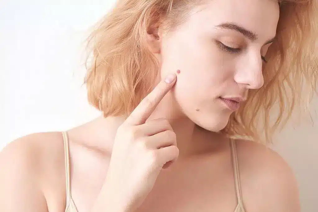 Wart-Free Wonders: Discover Dubai’s Advanced Removal