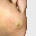Personalized Skin Tag Care in Dubai