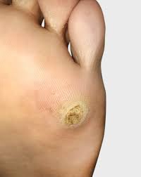 Personalized Skin Tag Care in Dubai