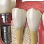Will I Need Bone Grafting Before Getting Dental Implants in Dubai