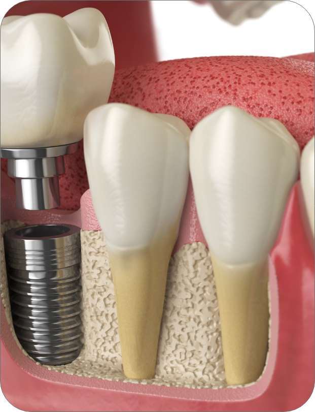 Will I Need Bone Grafting Before Getting Dental Implants in Dubai