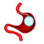Gastric Balloon Placement for Weight Loss
