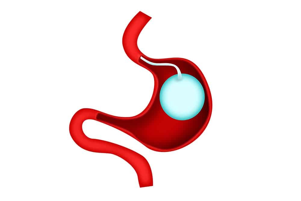 Gastric Balloon Placement for Weight Loss