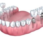Can Implants Get Cavities?