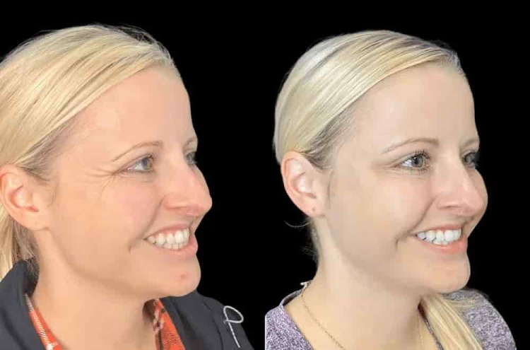 Exploring the Skill of the Best Plastic Surgeon in Dubai for Botox Procedures