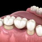Dental Crowns and Bridges for Gaps