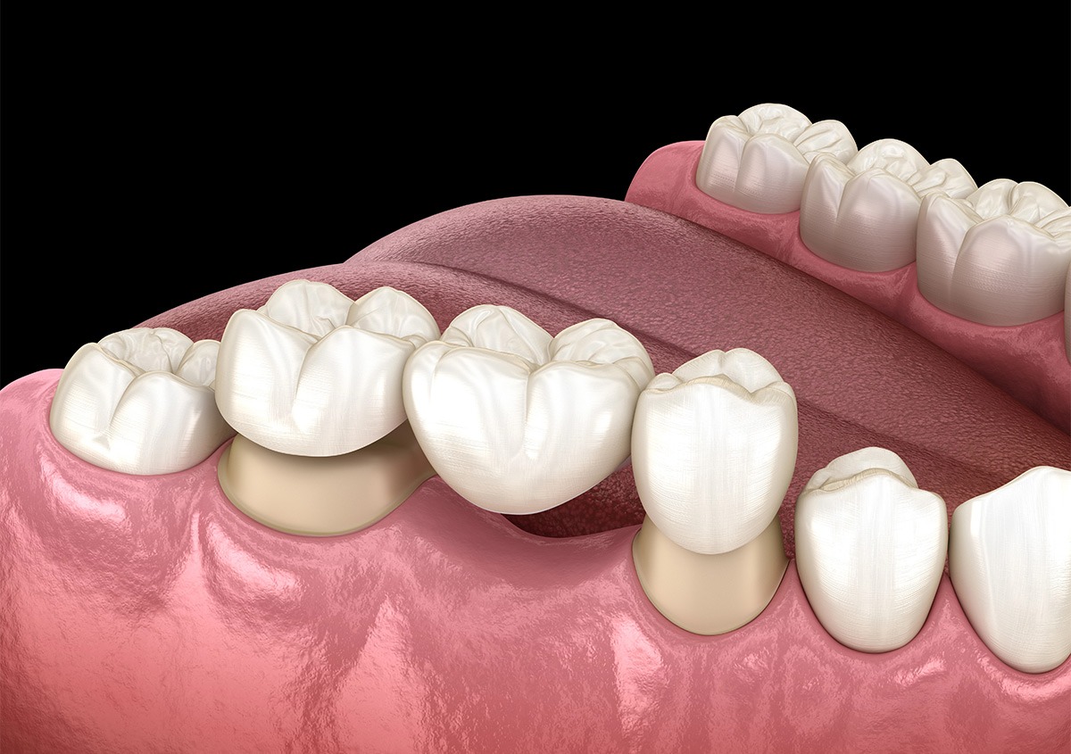 Dental Crowns and Bridges for Gaps