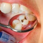 What’s the Average Tooth Filling Cost?