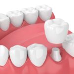 How Dental Crowns and Bridges Help