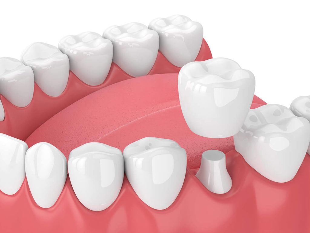 How Dental Crowns and Bridges Help