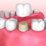 Temp Crown Pain and How Long Do Temporary Crowns Last