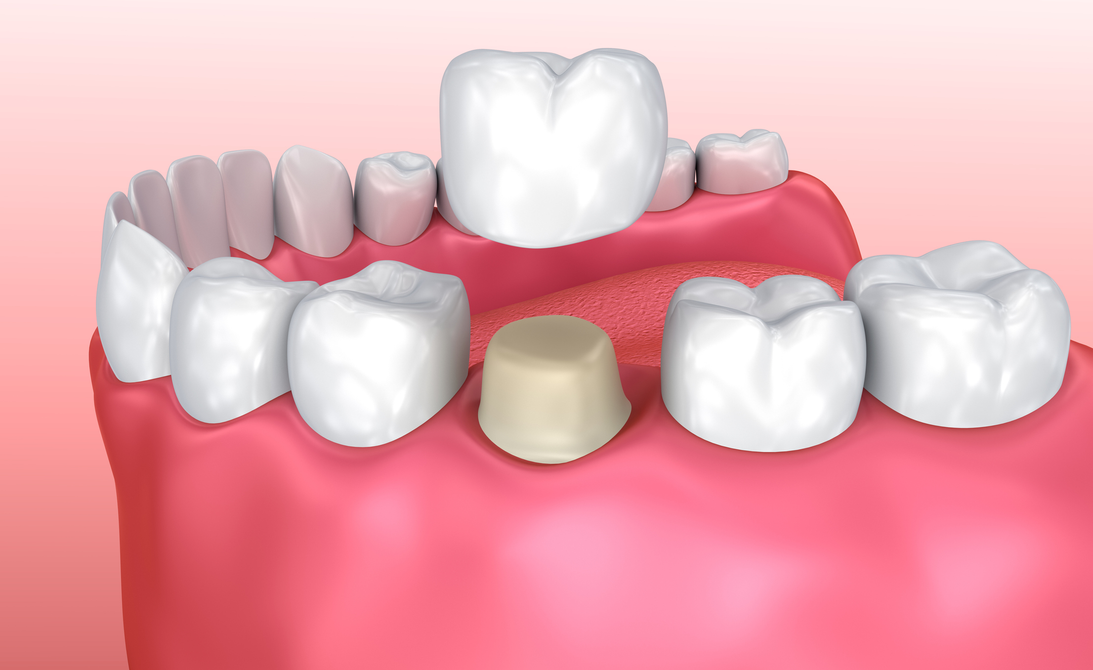 Temp Crown Pain and How Long Do Temporary Crowns Last