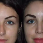 Best Septoplasty Surgeon in Dubai for Breathing Problems