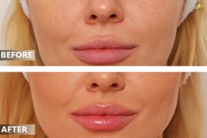 Juvederm Fillers in Dubai