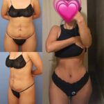 Tummy Tuck: What the Best Doctors in Dubai Recommend for Faster Healing