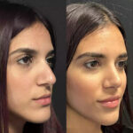 Step-by-Step Care with the Best Septoplasty Surgeon in Dubai