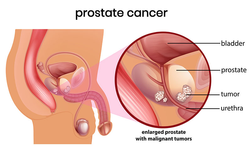 What International Patients Should Know About Prostate Cancer Treatment in India
